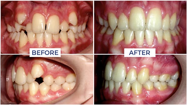 Before & After - Dental Treatment